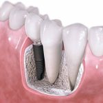 dental-implants_lhtu